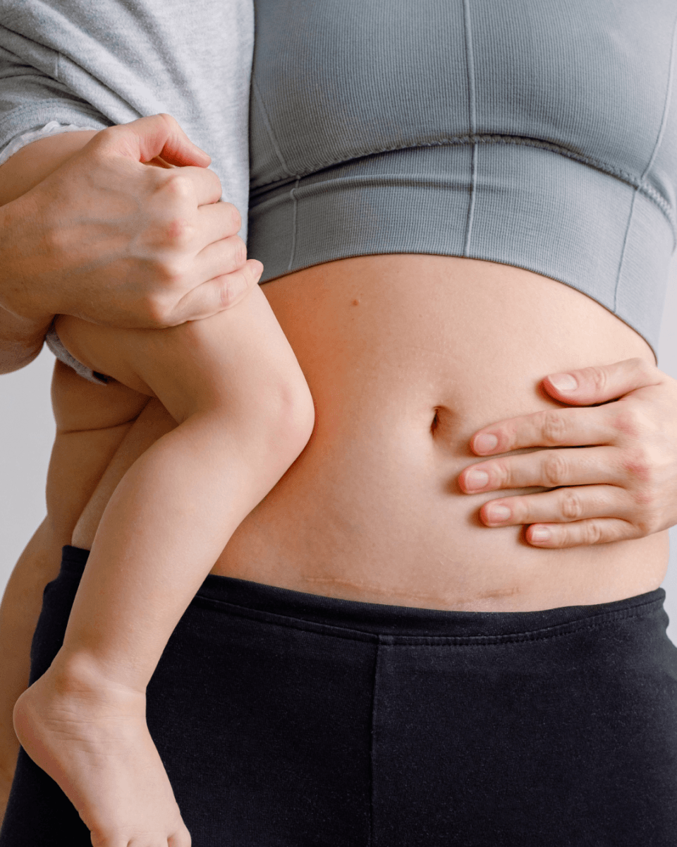 Returning to Exercise After a C-Section: What Mums Actually Need to Know